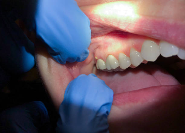 Tooth Infection Emergency Dentist in MO